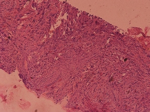 Микроскопическая картина РМЖ (окраска гематоксилин-эозин; увеличение ×100 и ×400). Столбиковая биопсия.