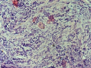 Микроскопическая картина РМЖ (окраска гематоксилин-эозин; увеличение ×100 и ×400). Столбиковая биопсия.